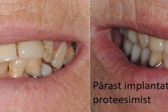 hammaste-proteesimine