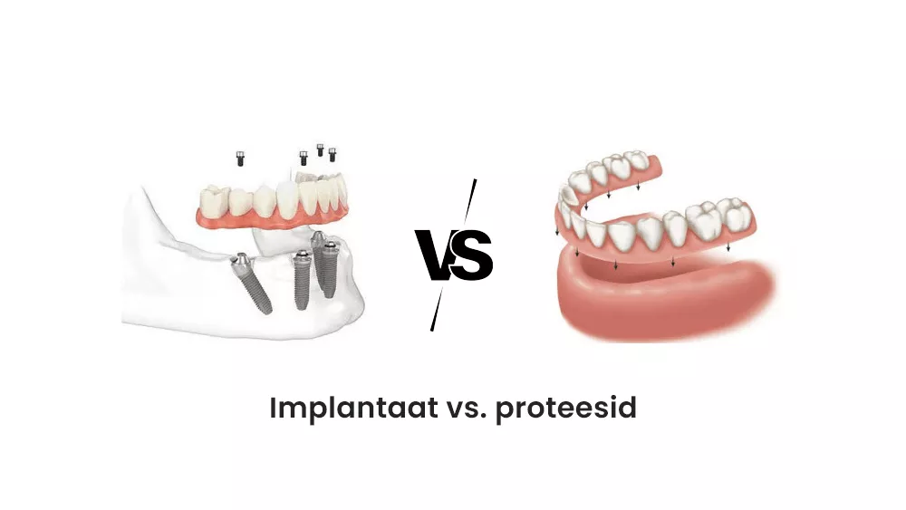 Implantaat vs. proteesid: Kumb valik on teie jaoks parem?