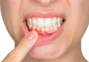 Gum Disease Prevention