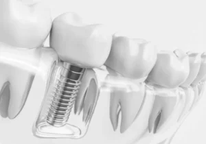 Care for Implants: Recommendations and Tips