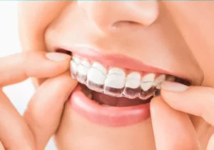 Orthodontic Aligners at HanzaDent: Step-by-Step